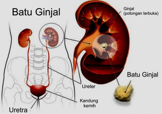 Illustration for article titled obat batu ginjal de nature
